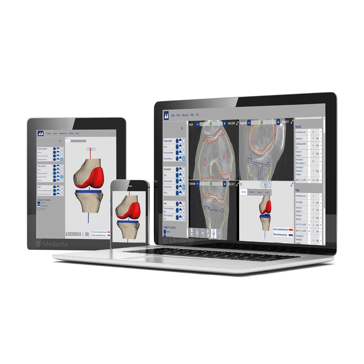 Pose de prothèse avec guides MyKnee