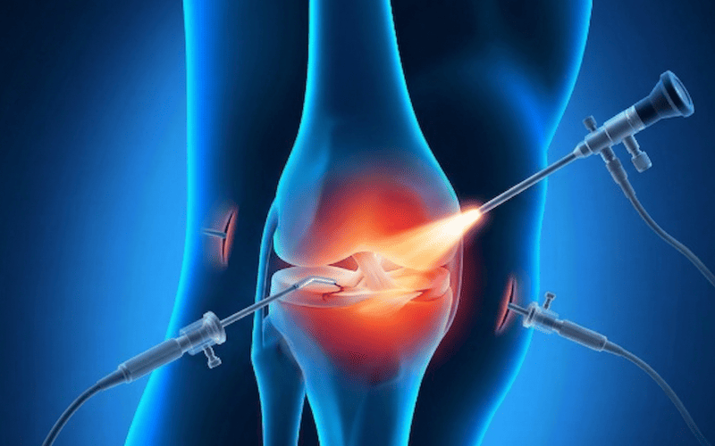 Arthroscopie du genou